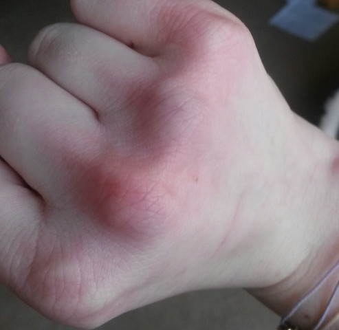 Finger Tapen Bei Fingerknochelchenprellung Medizin Arzt Verletzung Finger Tapen Bei Fingerknochelchenprellung Medizin Arzt Verletzung