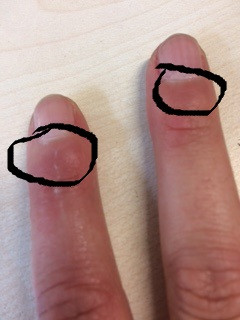 Finger Unterhalb Nagel Geschwollen Fingernagel