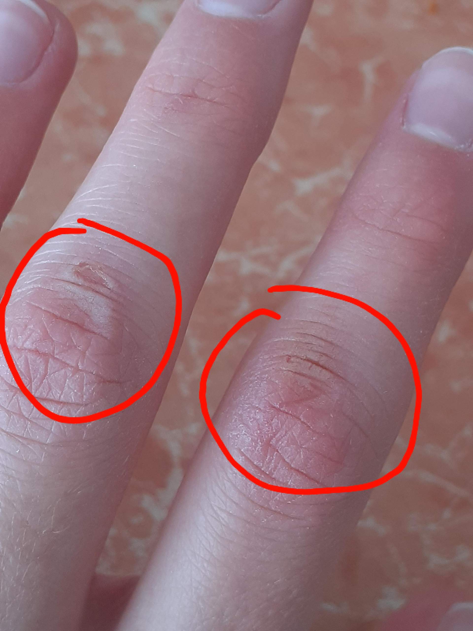 Finger verbrannt? (Gesundheit und Medizin, Gesundheit, Verbrennung)