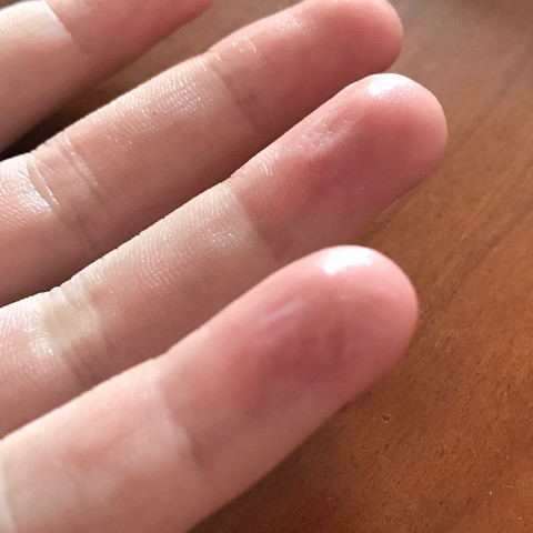 Finger - (Schmerzen, Verletzung, Finger)
