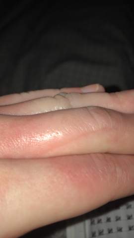 Finger Verbrannt Welcher Grad In Etwa Gesundheit Und Medizin Verbrennung Finger Verbrannt Welcher Grad In Etwa Gesundheit Und Medizin Verbrennung