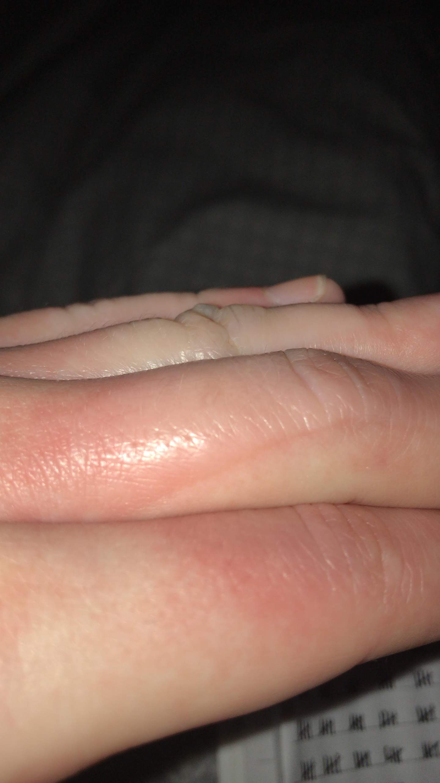 Finger verbrannt.. welcher grad in etwa? (Gesundheit und Medizin