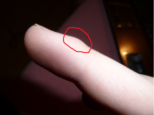 - (Sport, Verletzung, Finger)