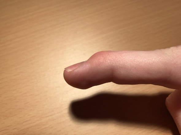 Lange wie geschwollen verstaucht finger Verletzung Fingergelenk