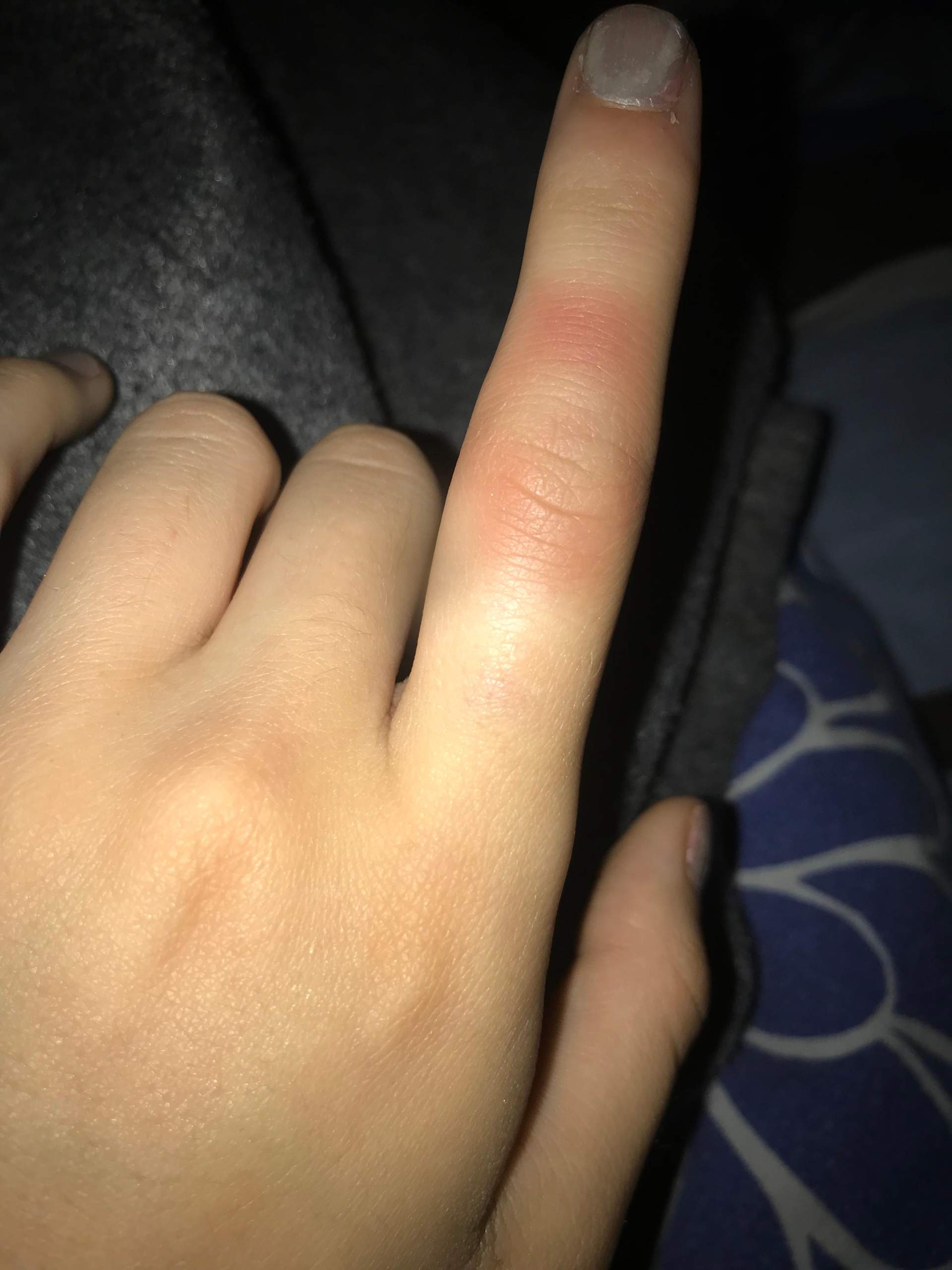 Impoliment sommet physiquement finger verstaucht wie lange geschwollen