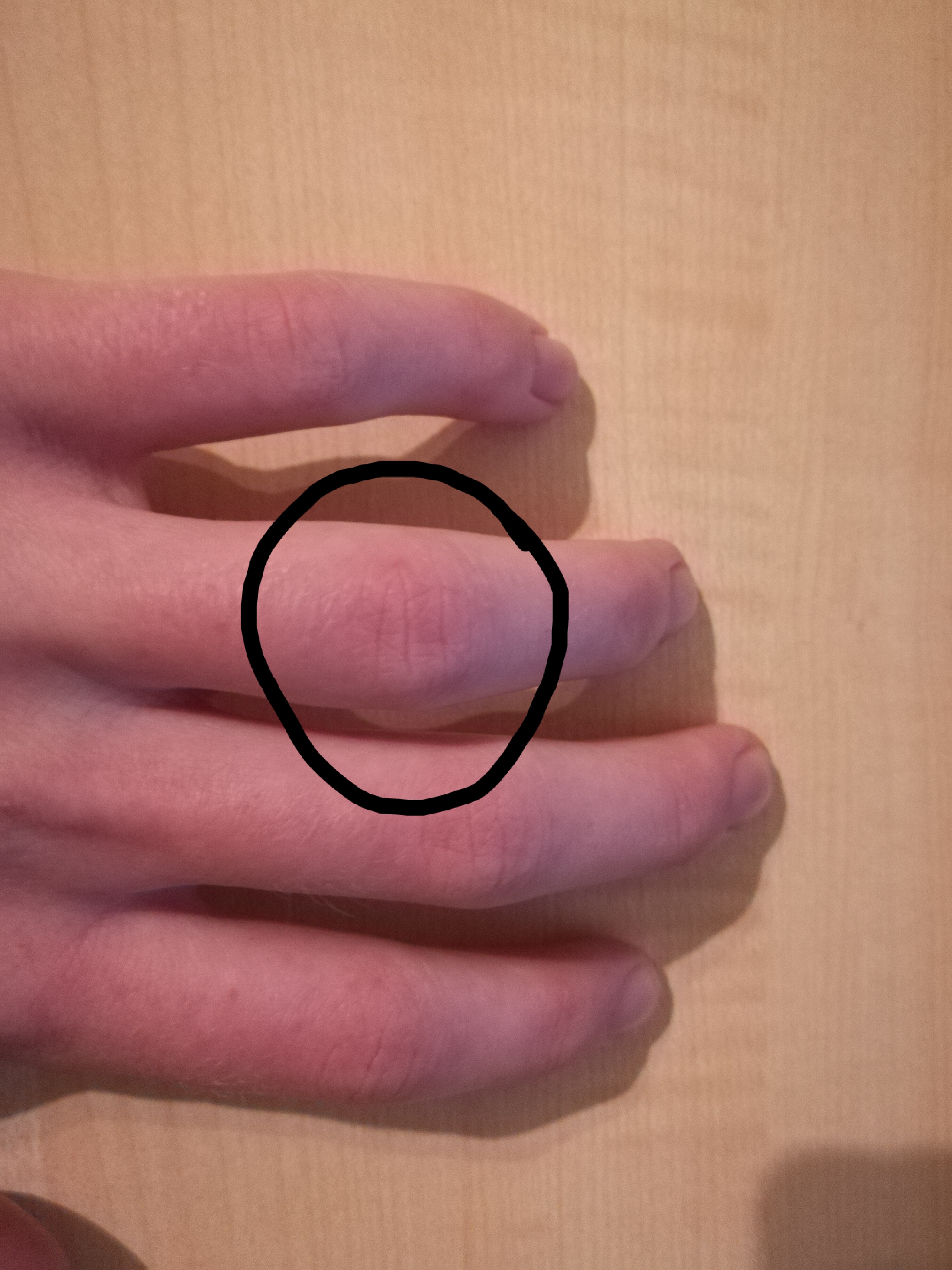 Finger verstaucht, soll ich gleich zum Arzt? (Gesundheit, Gesundheit und Medizin, Medizin)