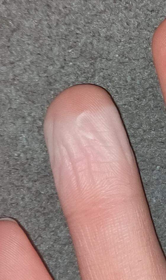 Finger wegen Pflaster Was tun? (Gesundheit und Medizin, Gesundheit, Haut)