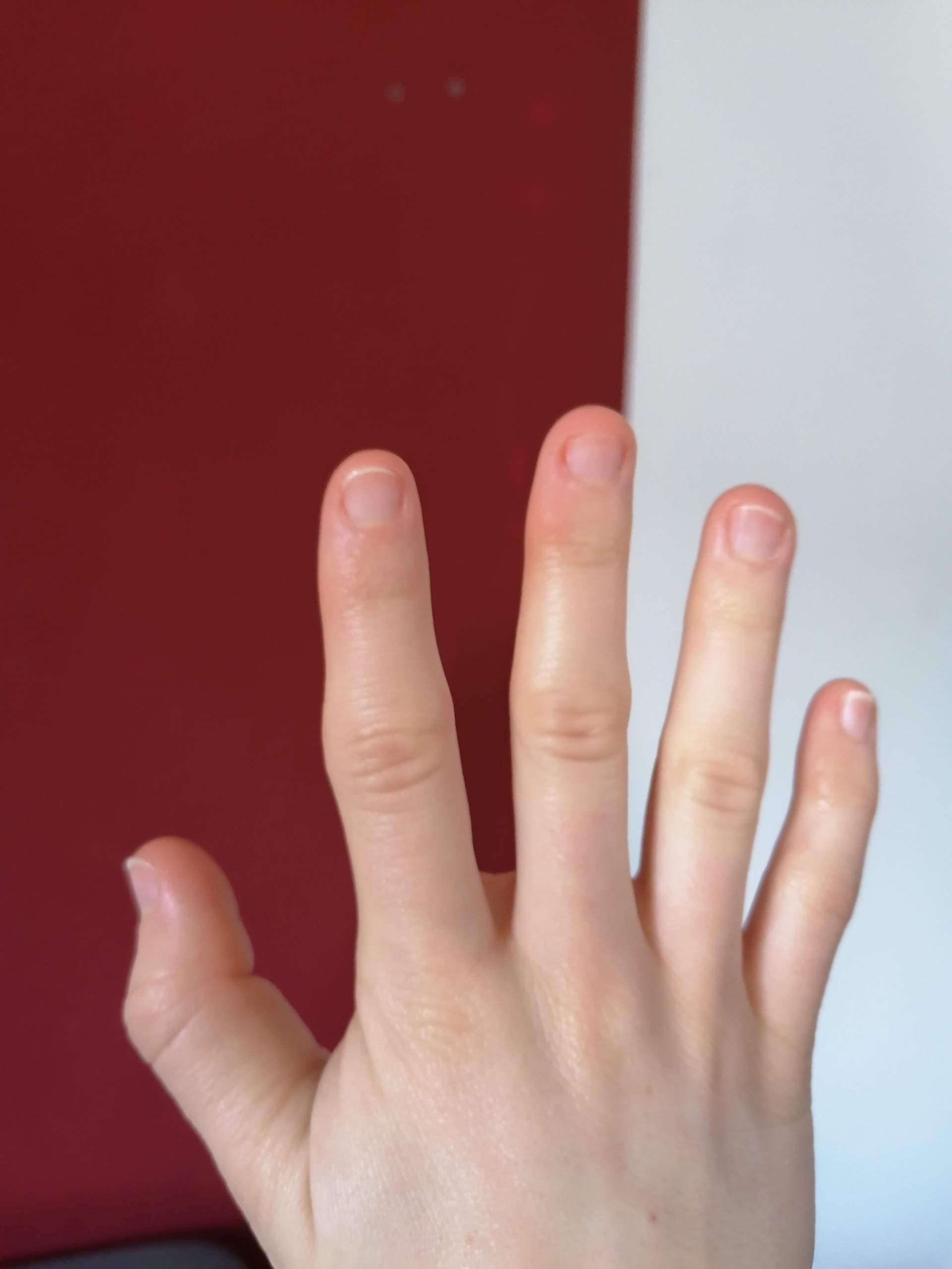 Finger knubbel Heberden Knötchen
