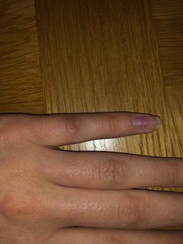 Finger Zeigen Gehen Gesundheit Und Medizin Kratzer