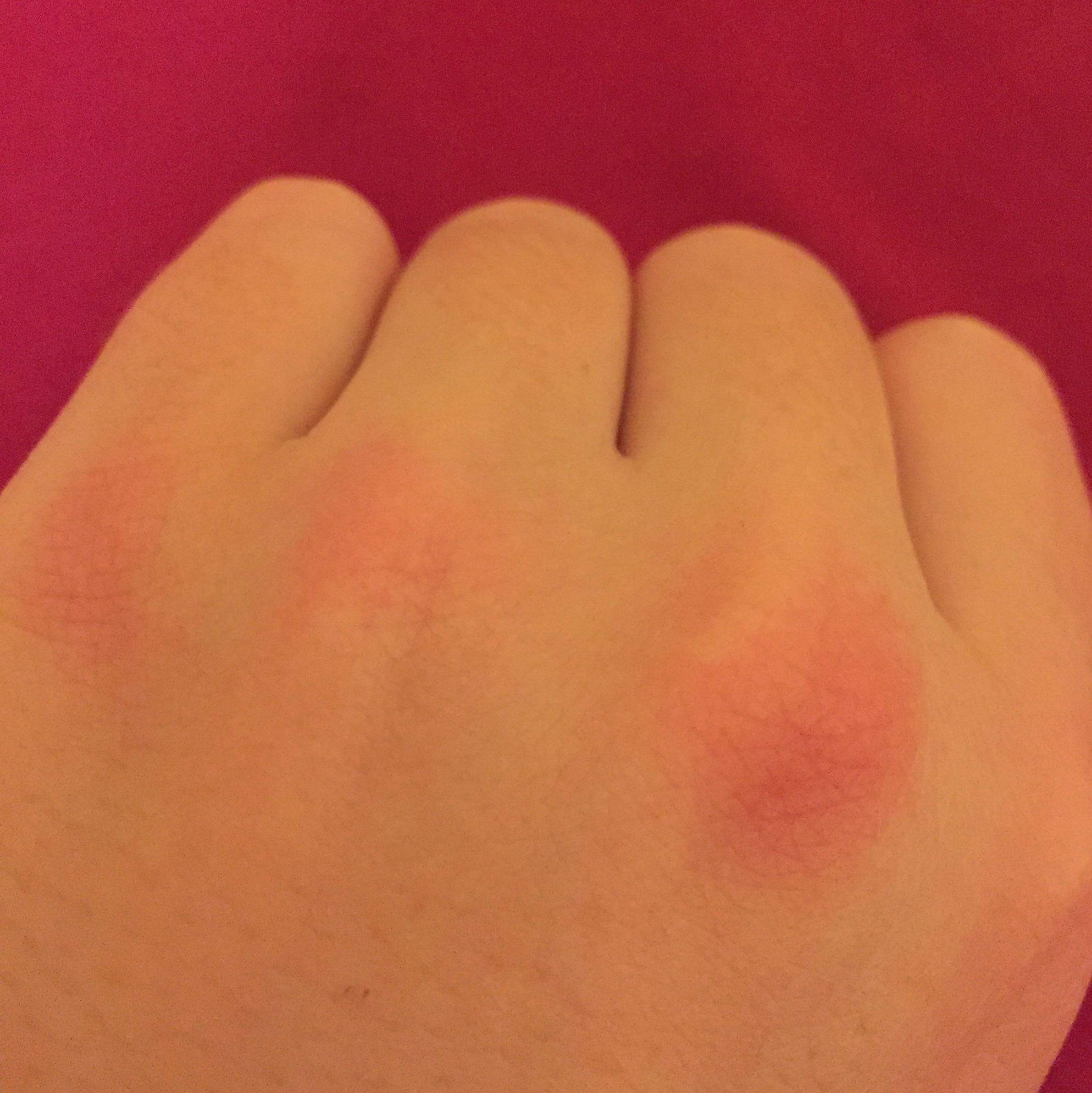 Fingerknöchel rot und angeschwollen? (Krankheit, krank)