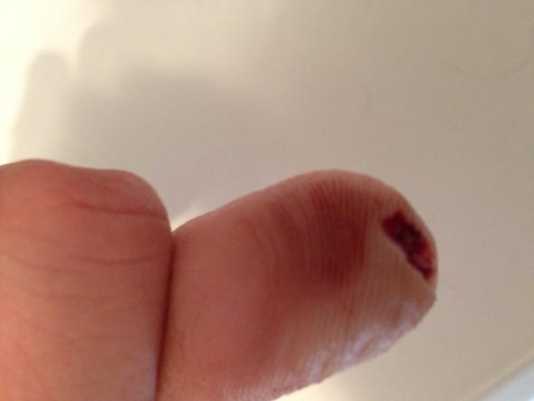 Fingerkuppe Ab Wielange Realistisch Krank Beruf Krankenpfleger Medizin Arzt Schneiden Fingerkuppe Ab Wielange Realistisch Krank Beruf Krankenpfleger Medizin Arzt Schneiden