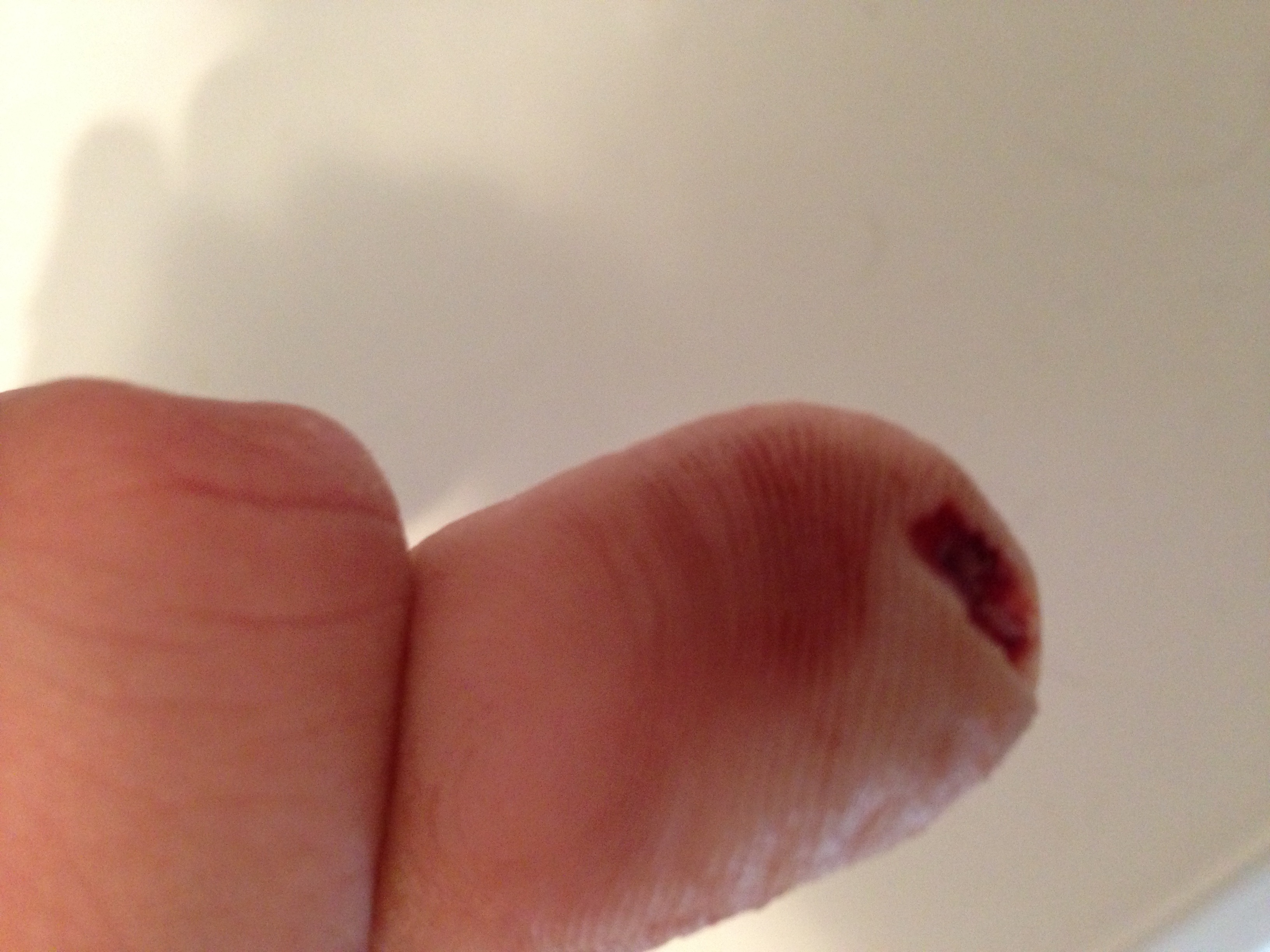 Heilung fingerkuppe abgetrennt ⚡ Abgetrennter