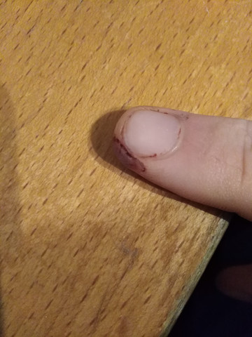 Fingerkuppe Geschnitten Haut Stirbt Ab Arzt Schneiden Fingerkuppe Geschnitten Haut Stirbt Ab Arzt Schneiden