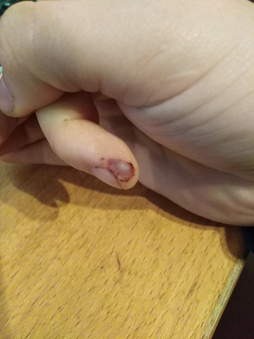 Fingerkuppe Geschnitten Haut Stirbt Ab Arzt Schneiden Fingerkuppe Geschnitten Haut Stirbt Ab Arzt Schneiden