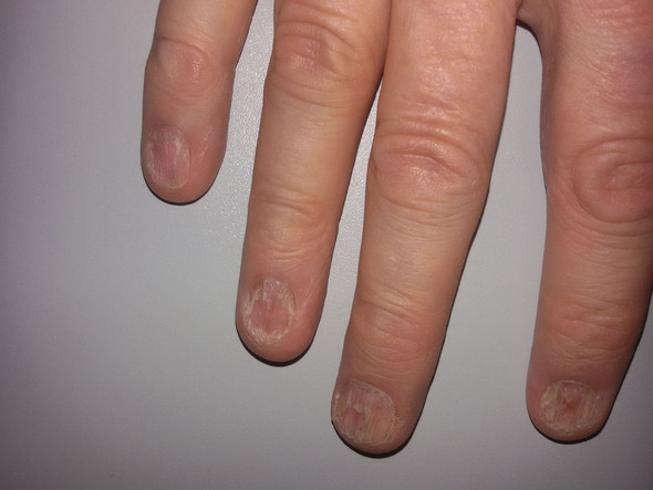 Fingernagel Brechen Ab Und Splittern Nagel Fingernagel Brechen Ab Und Splittern Nagel