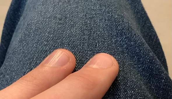 Fingernägel haben komische „Rillen“?