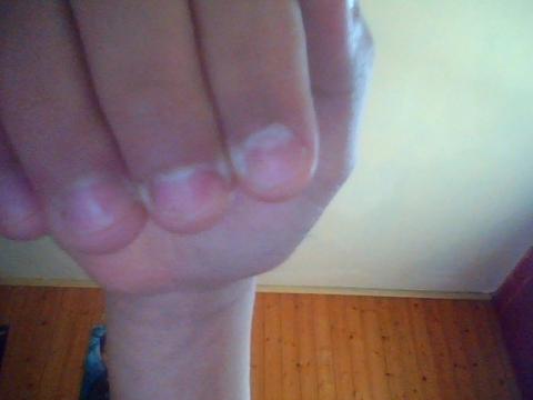 Sehen Fingernagel Aus Wie Fruher Wenn Man Mit Dem Kauen Aufhort Nagel