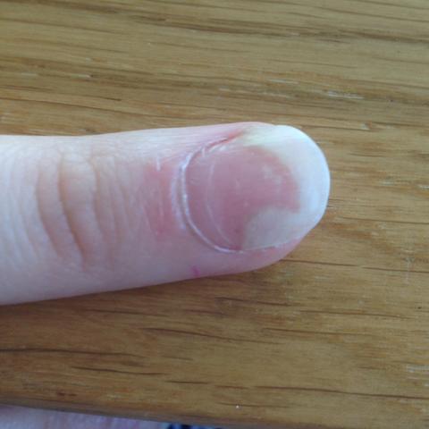 Mittelfinger - (Nägel, Fingernägel, nagelbett)