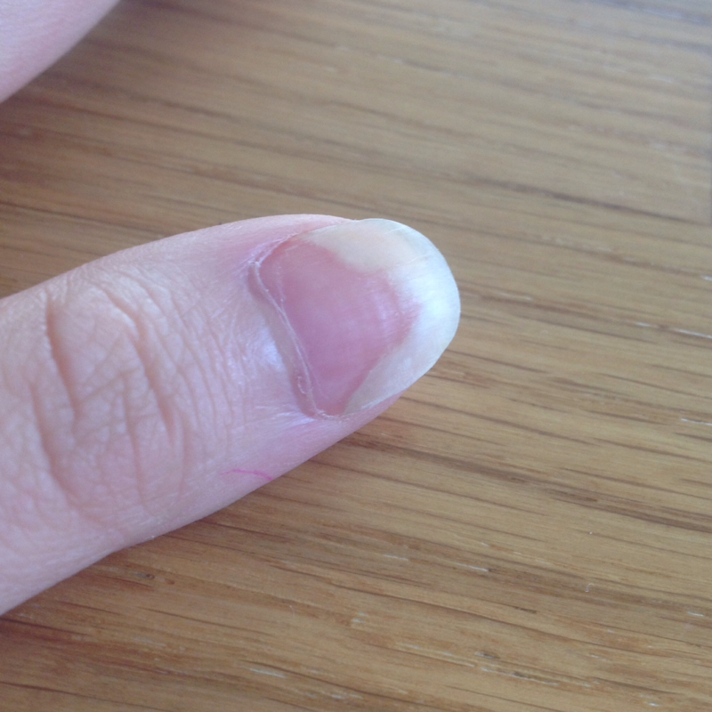 Fingernägel lösen sich! Hilfe? (Nägel, nagelbett) Fingernägel lösen sich! Hilfe? (Nägel, nagelbett)