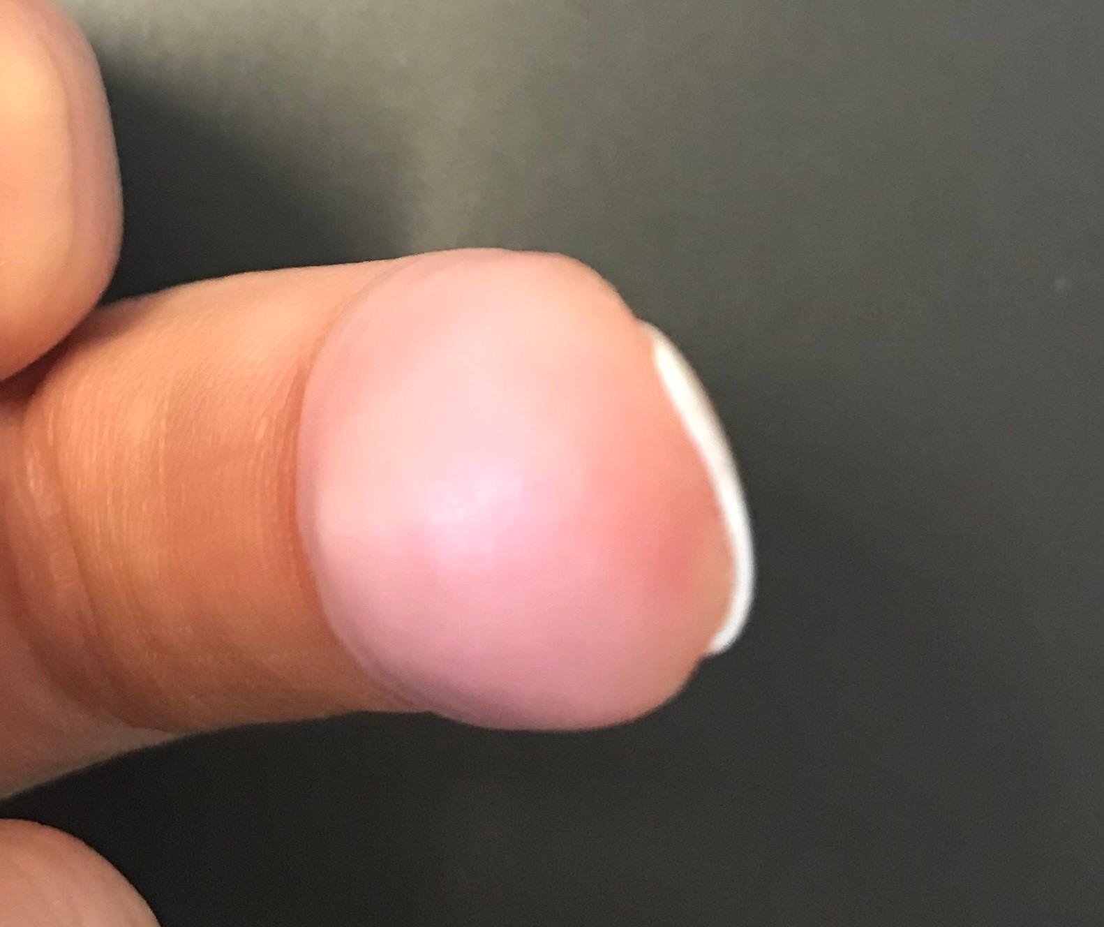 Fingernagel Wachsen Komisch Verbogen Warum Gesundheit Medizin