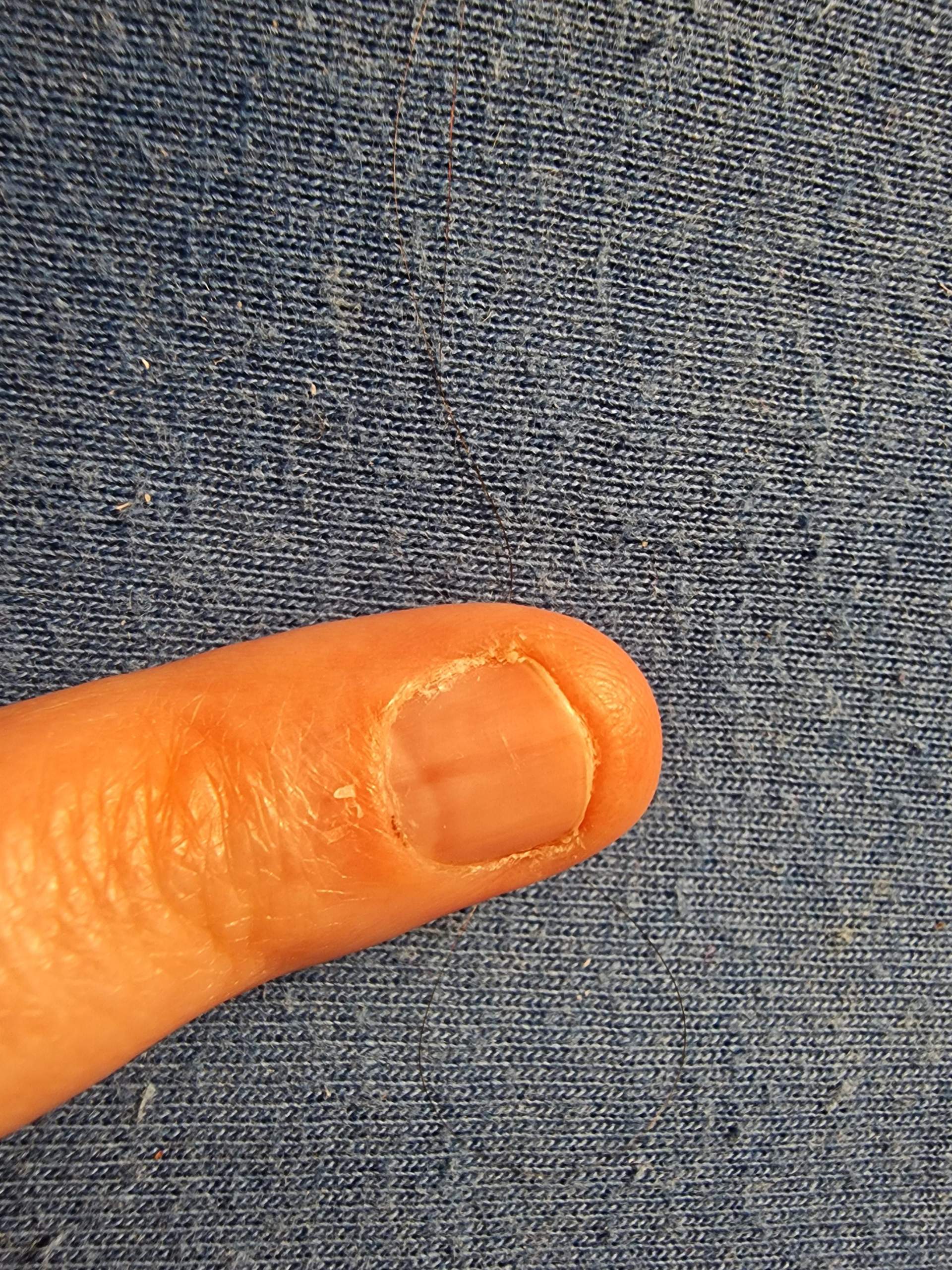 Fingernägel-was bedeutet diese Rille? (Gesundheit, Nägel, Rillen)