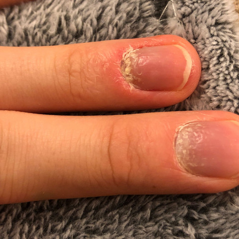 Fingernagel Weisse Stellen Gesundheit Und Medizin Gesundheit Medizin Fingernagel Weisse Stellen Gesundheit Und Medizin Gesundheit Medizin