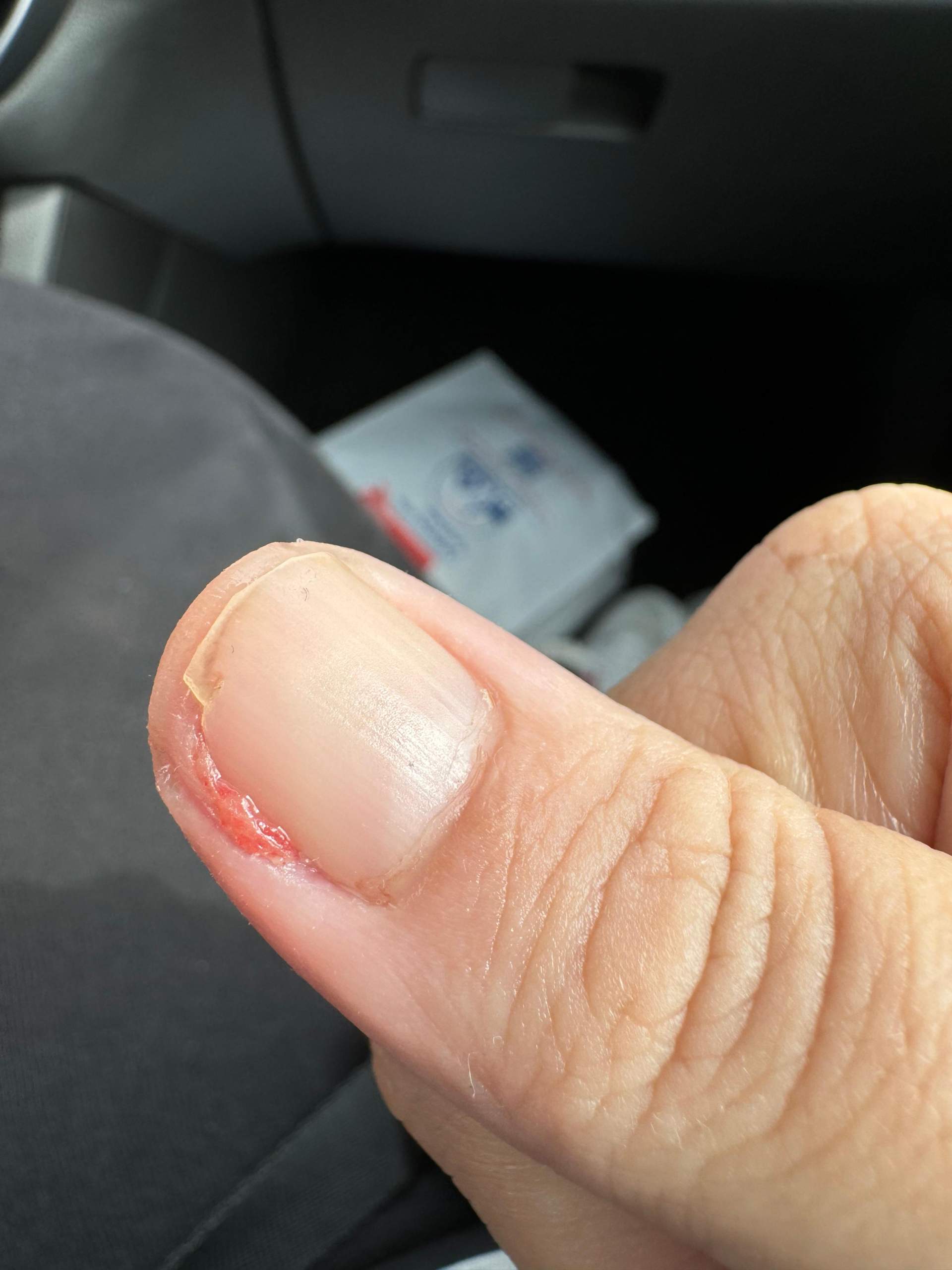 Fingernagel abgerissen was tun? (Haut, Nägel, Fingernägel)