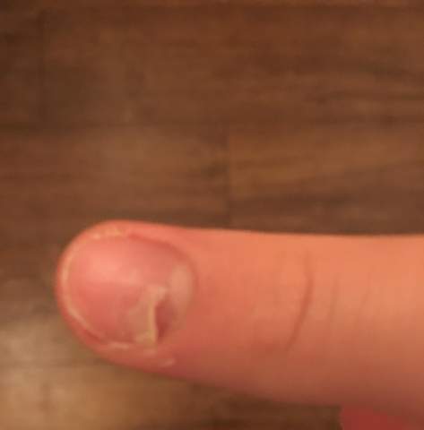Fingernagel Eingerissen Was Tun Abschneiden Nagel Fingernagel