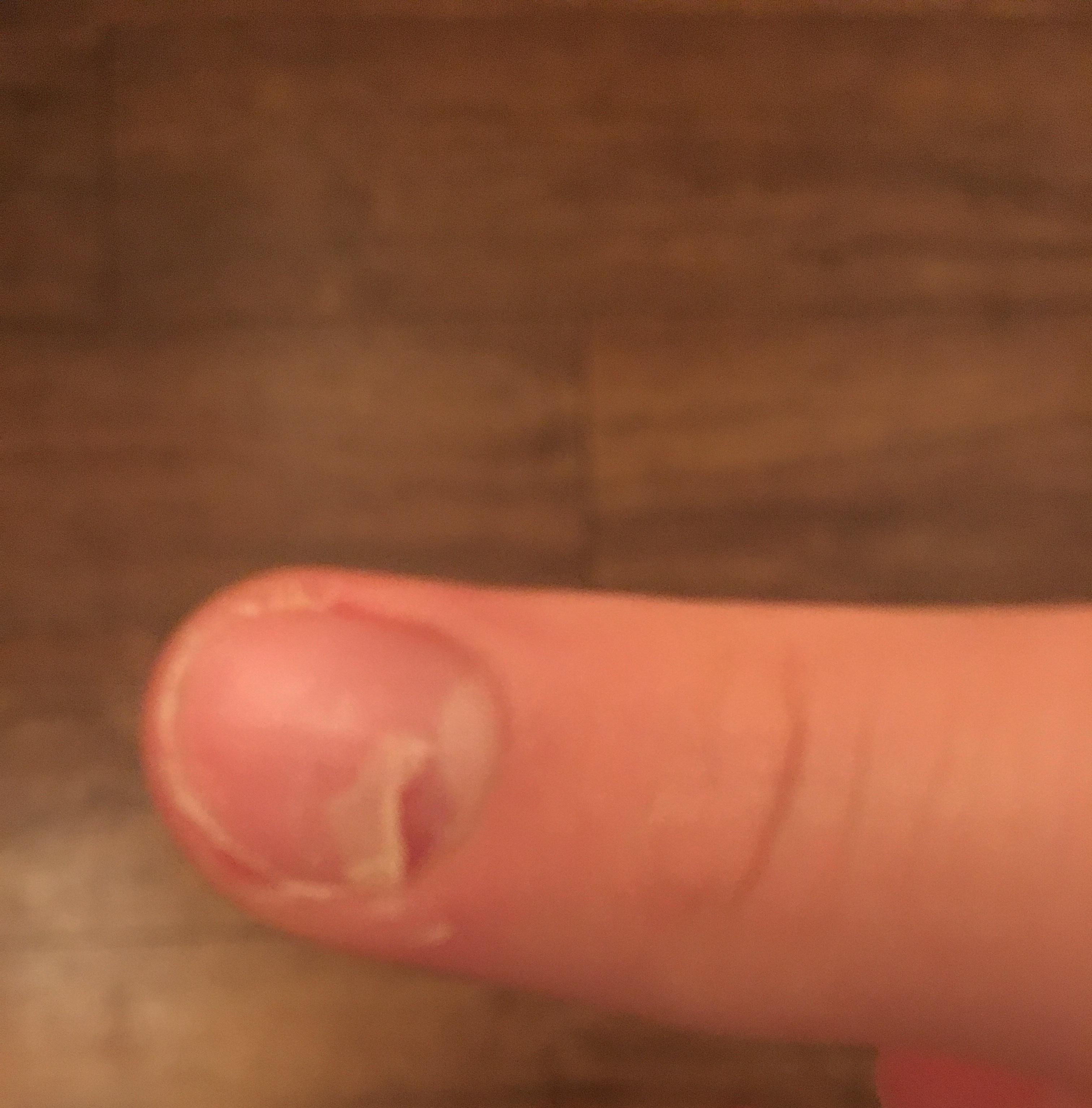 Fingernagel Eingerissen Was Tun Abschneiden Nagel Fingernagel Fingernagel Eingerissen Was Tun Abschneiden Nagel Fingernagel