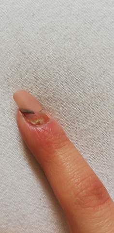 fingernagel entzundet rot gefarbt hand fingernagel nagelstudio