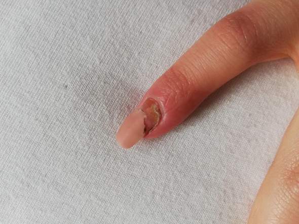 fingernagel entzundet rot gefarbt hand fingernagel nagelstudio