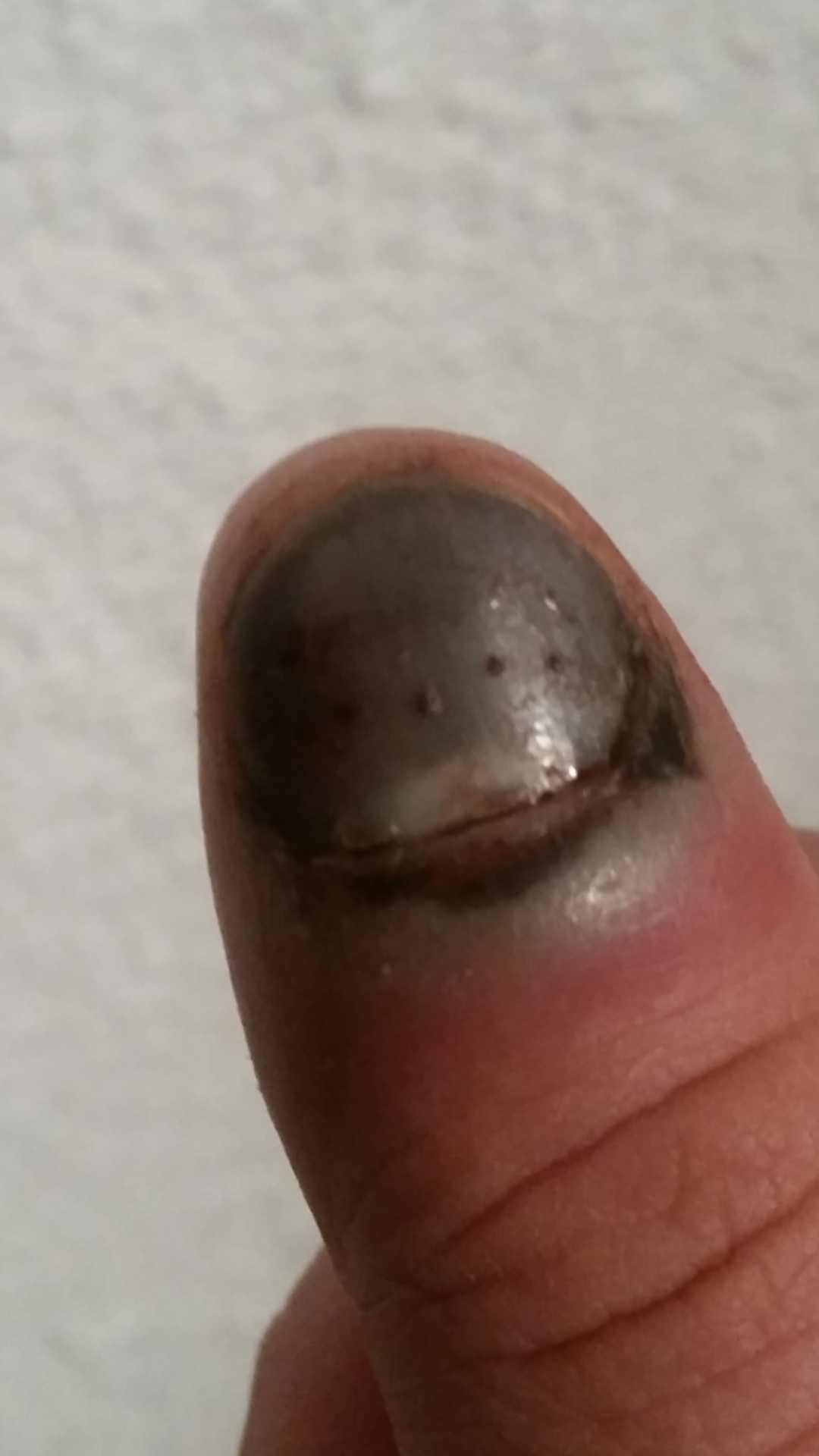 Finger In Tür Eingeklemmt Nagel Blau