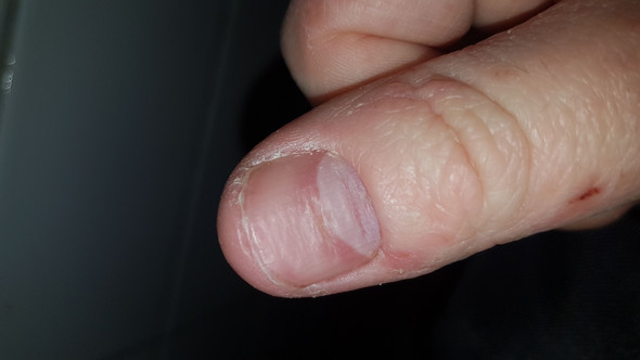 Fingernagel Verbeult Was Tun Gesundheit Hand Fingernagel