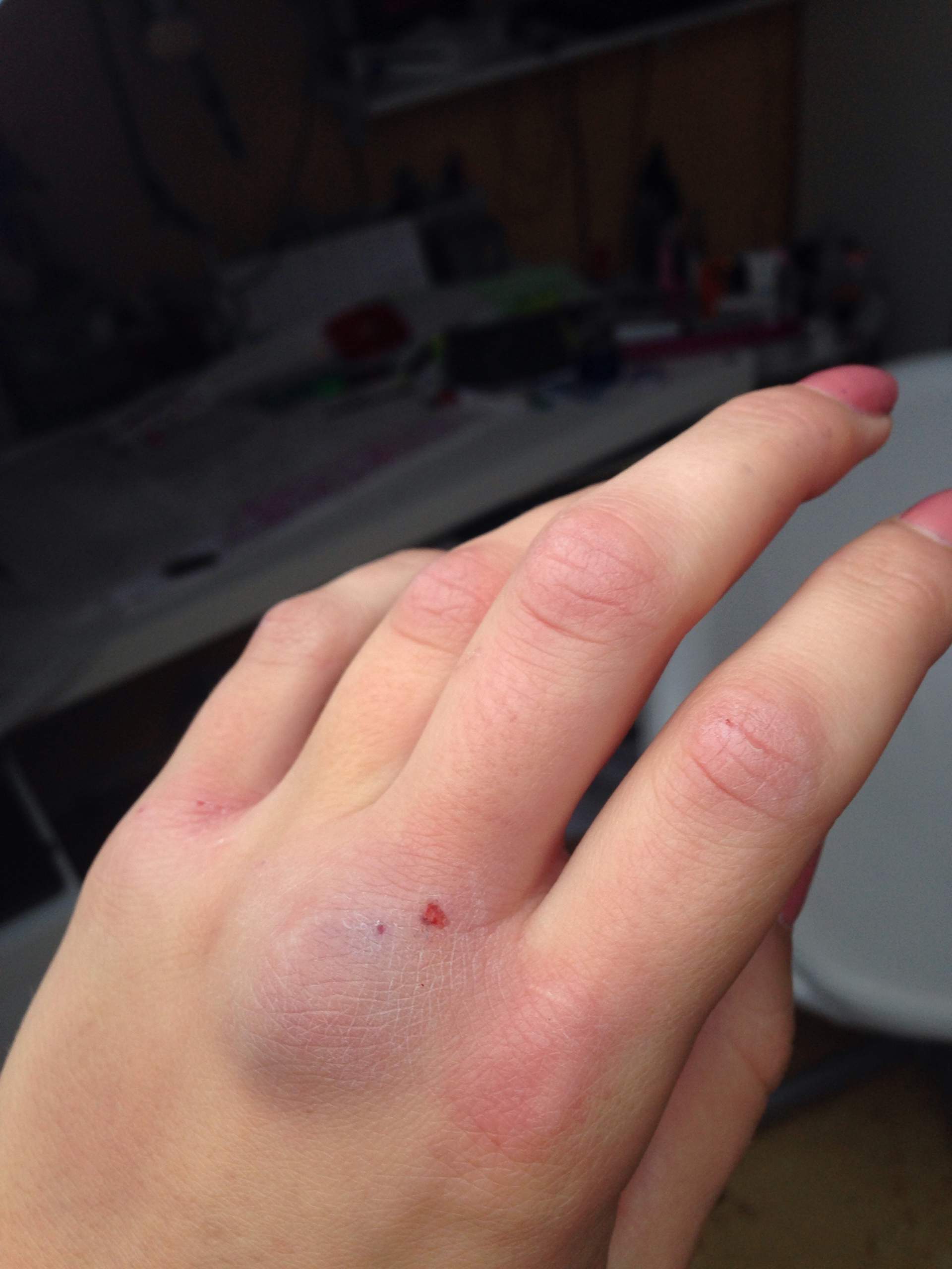 Finger brechen ohne schmerzen