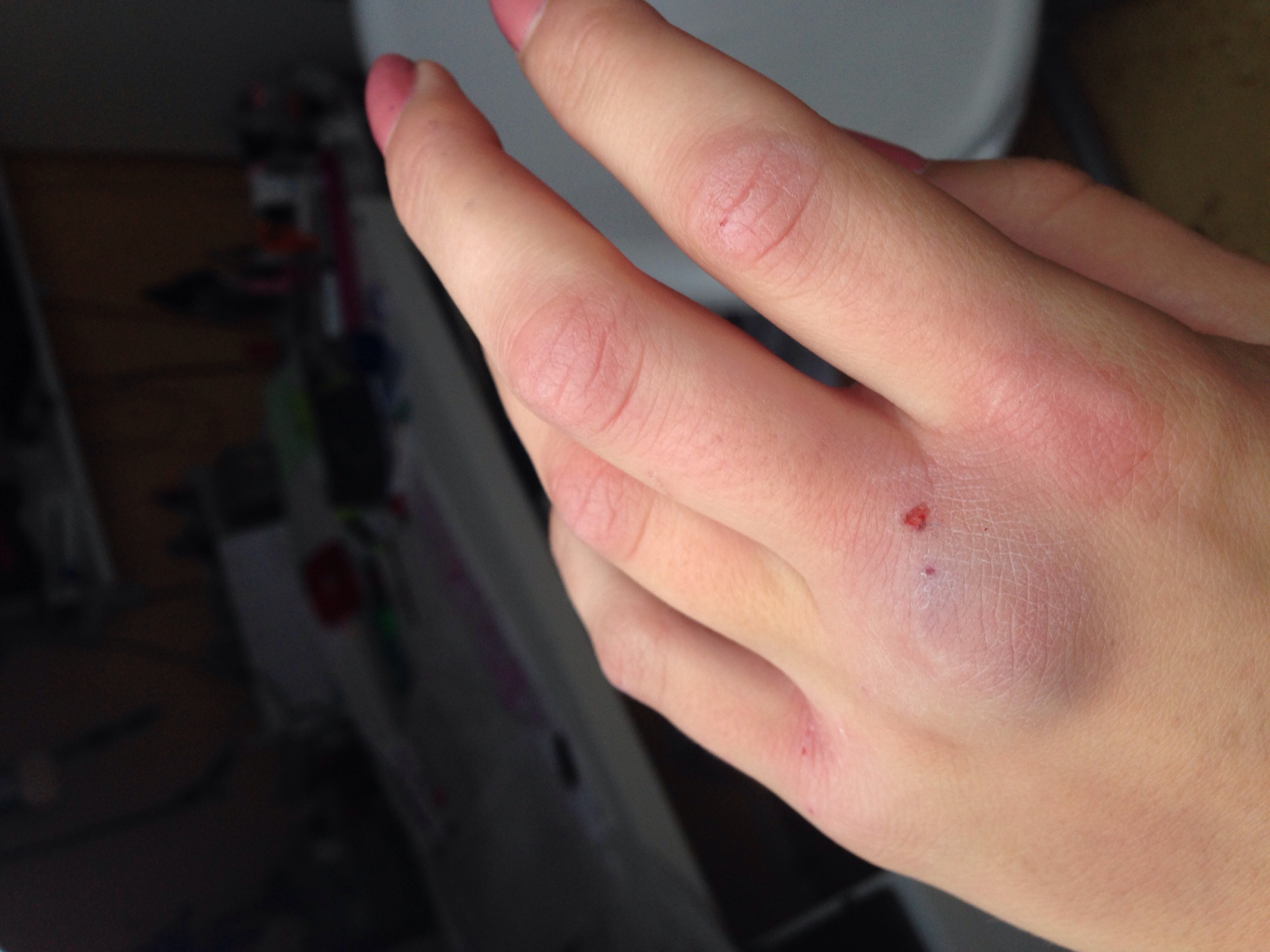 Fingerwurzelknochen Brechen Finger Bruch Fingerwurzelknochen Brechen Finger Bruch