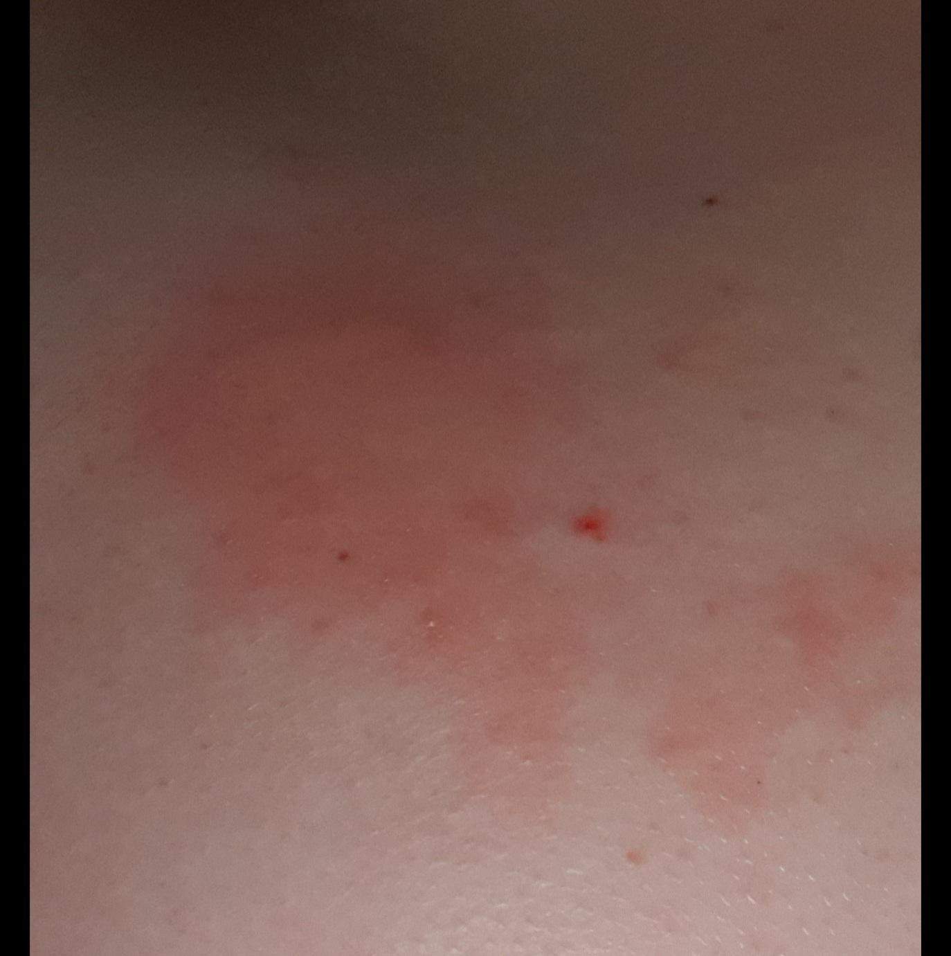 Fläche auf der Brust brennt und ist rot? (Gesundheit und Medizin, Haut)