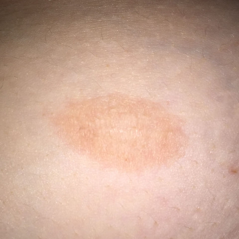 Was kann das für ein Fleck sein? - (Bauch, Flecken)