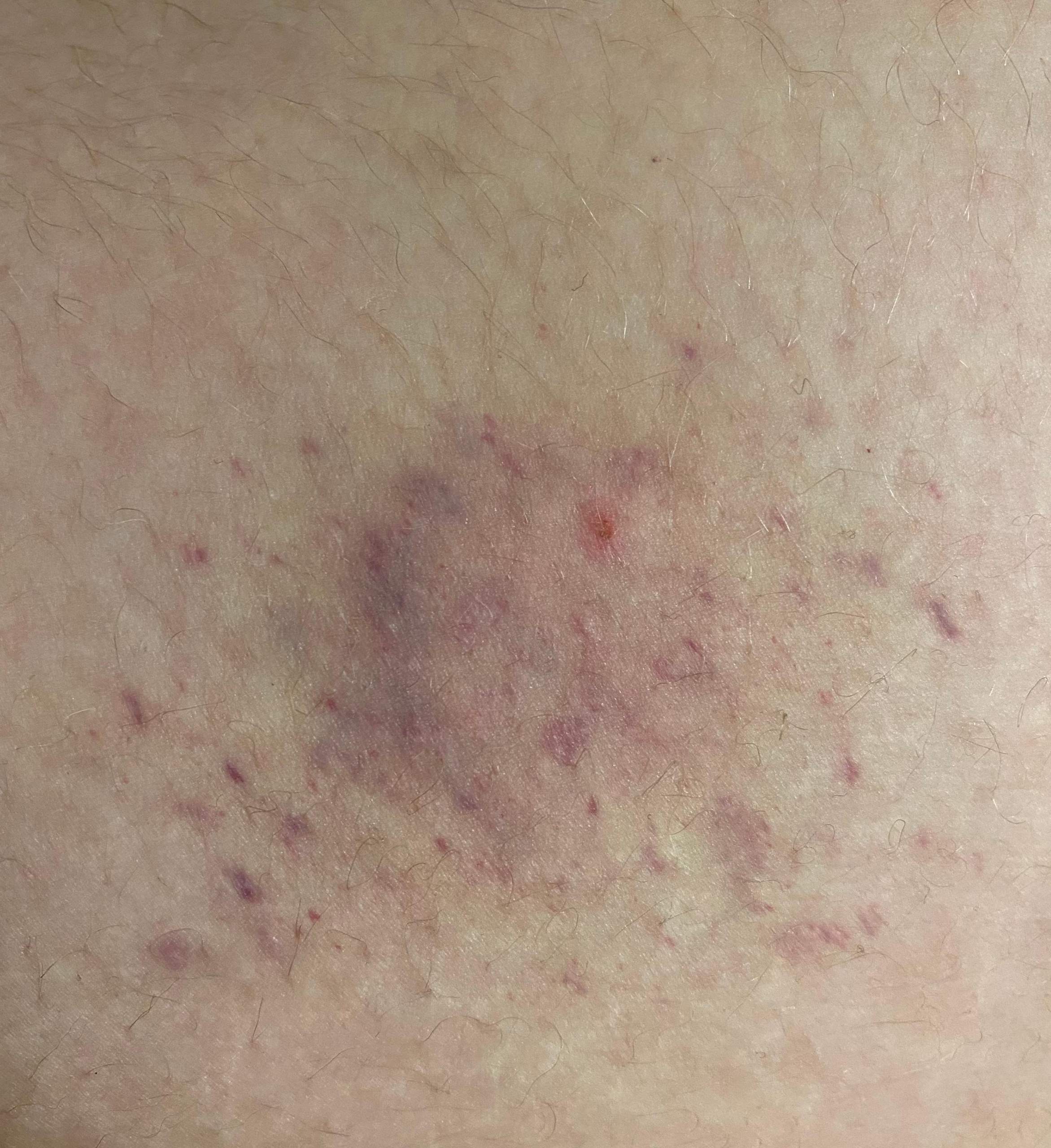 Fleck an meinem Oberschenkel ? (Gesundheit und Medizin, Flecken)