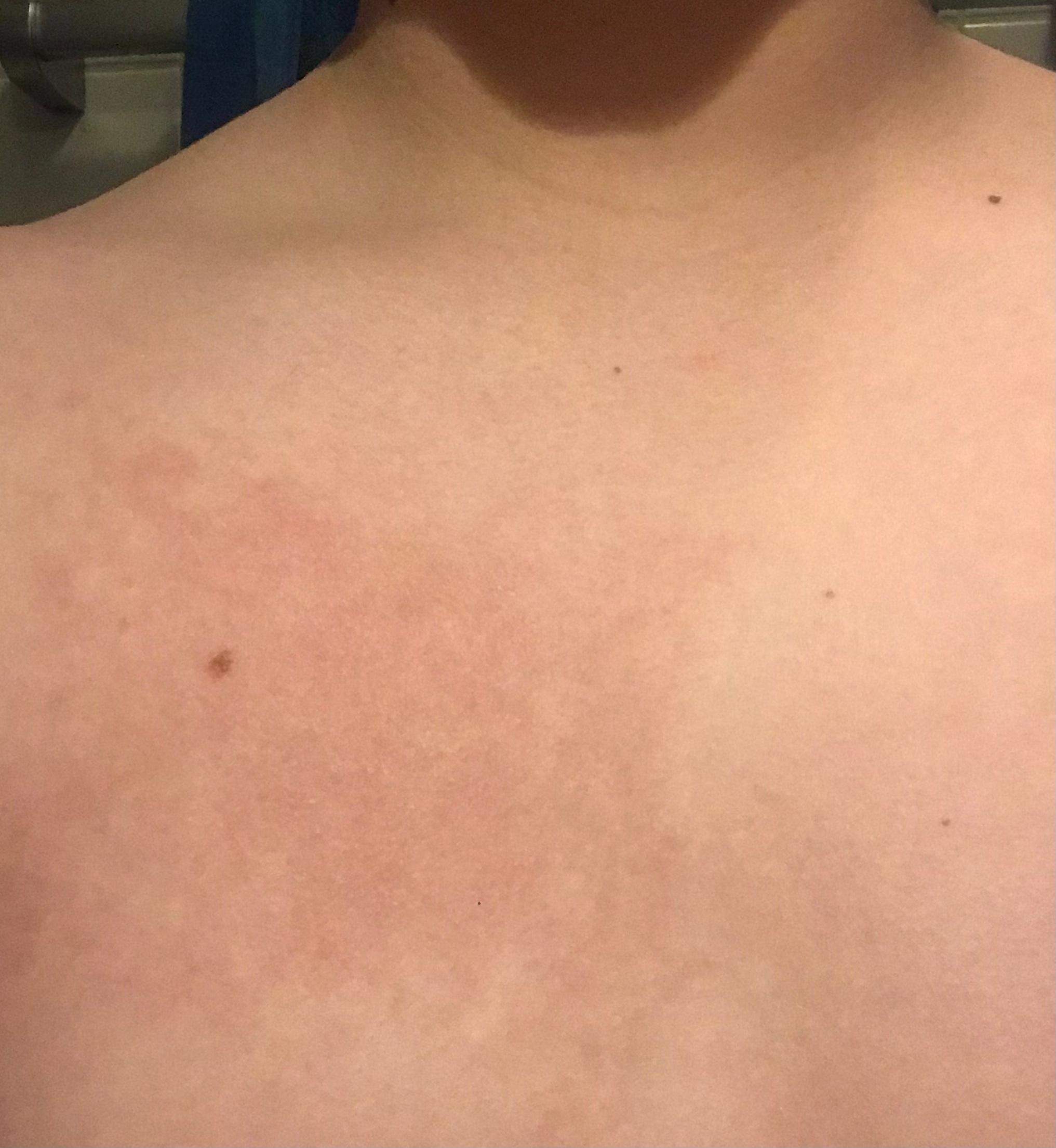 Fleck auf der Brust? (Gesundheit und Medizin, Gesundheit, Haut) Fleck auf der Brust? (Gesundheit und Medizin, Gesundheit, Haut)