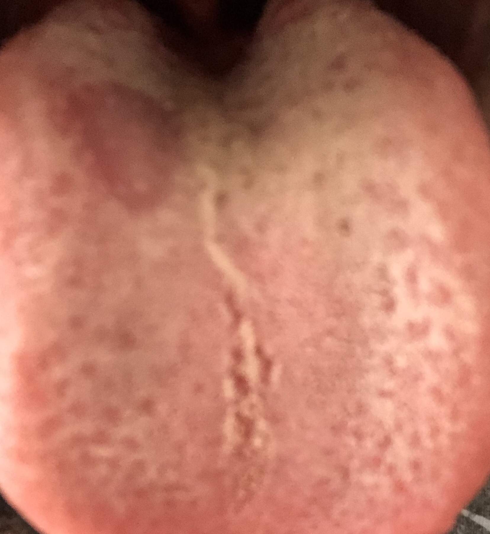 Fleck auf der Zunge, Krankheit? (Gesundheit und Medizin, Gesundheit, Arzt)