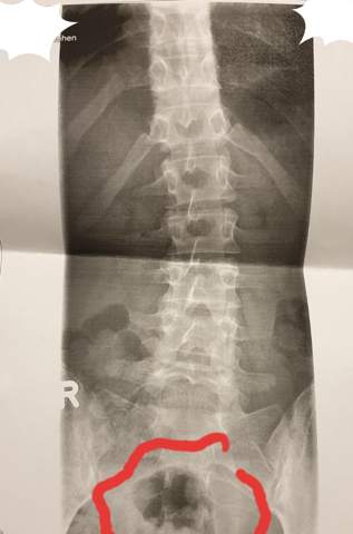 Fleck Auf Rontgenbild Gesundheit Und Medizin Gesundheit Fleck Auf Rontgenbild Gesundheit Und Medizin Gesundheit