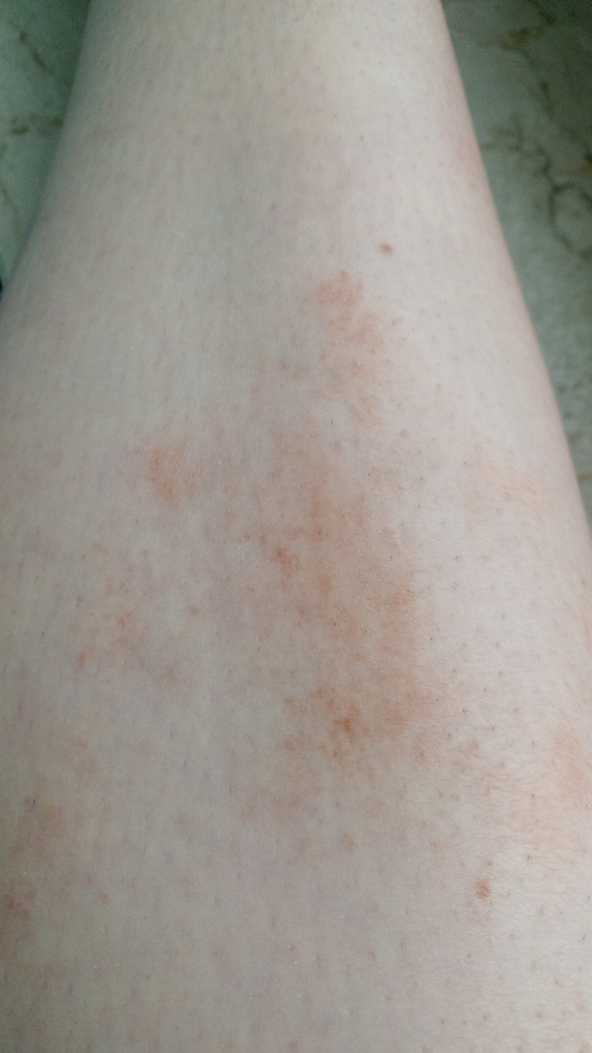 Fleck Ausschlag am Bein seit Jahren. Was ist es? (Gesundheit, Medizin