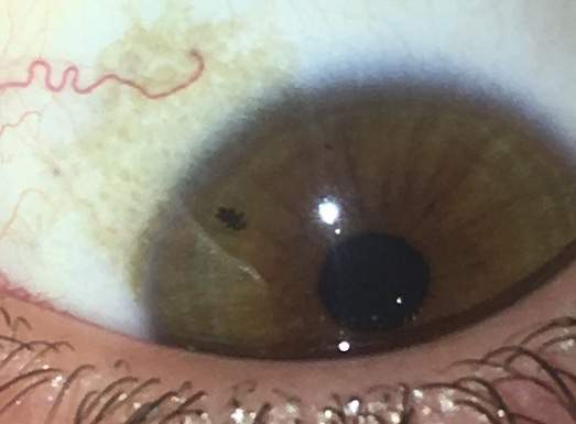 Fleck Im Augenweiss Augen Flecken Fleck Im Augenweiss Augen Flecken