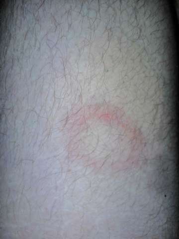 Fleck Mit Rotem Rand Gesundheit Und Medizin Gesundheit Haut Fleck Mit Rotem Rand Gesundheit Und Medizin Gesundheit Haut