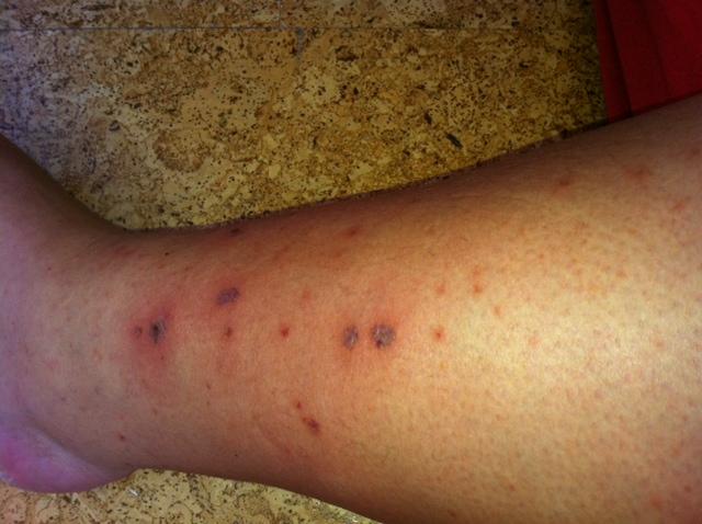 Flecken / wunden an den Beinen? (Medizin, Thrombose) Flecken / wunden an den Beinen? (Medizin, Thrombose)