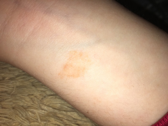 Flecken Am Arm Was Konnte Es Sein Gesundheit Und Medizin Hautausschlag Rote Flecken