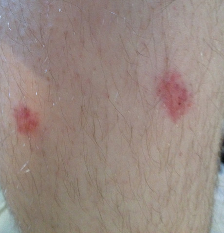 Bild 2 - (Haut, Pickel, Flecken)