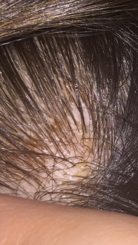 Flecken Auf Dem Kopf Juckt Brennt Gesundheit Krankheit Stress