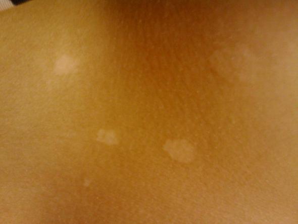 Flecken Auf Der Haut Bild Vorhanden Medizin Arzt Krankheit Flecken Auf Der Haut Bild Vorhanden Medizin Arzt Krankheit