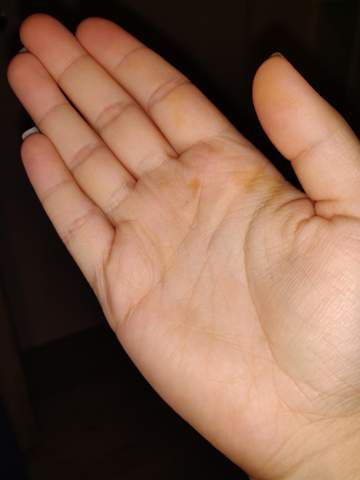 Flecken Auf Der Haut Was Soll Das Gesundheit Und Medizin Gesundheit Krankheit